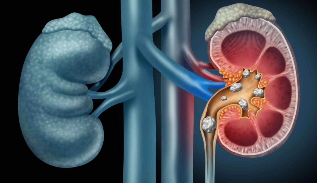 kidney disease